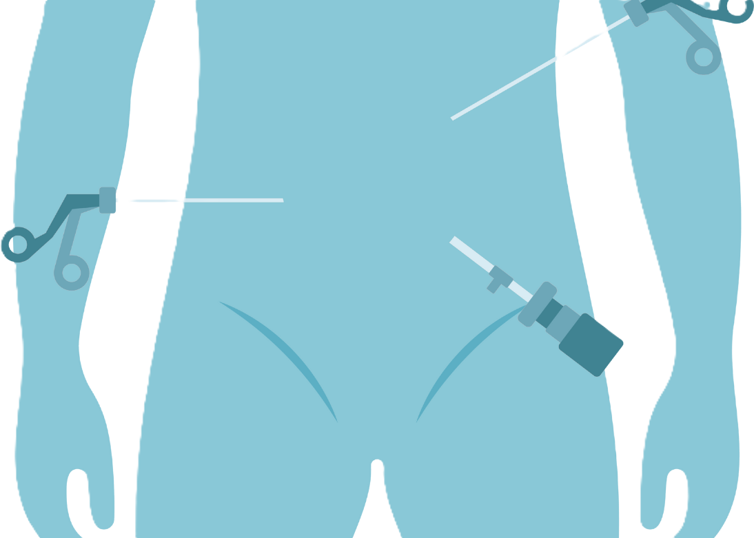 Minimally Invasive